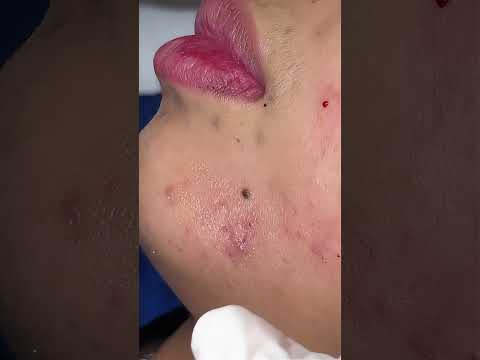 ตอนทำ นานกว่านี้ รีวิวกดสิวเรื้อรัง สิวเยอะแค่ไหน คลินิกก็ช่วยเคลียร์ได้! รักษาสิวครบขั้นตอน 700.-