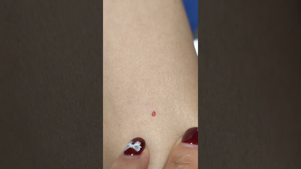 ไฝแดง (Cherry Angioma) คืออะไร? ต่างจากไฝดำไหม ใช้อะไรกำจัด? หมอพามาดู! ดีเลิฟเวอรี่คลินิก #หมอต้าร์