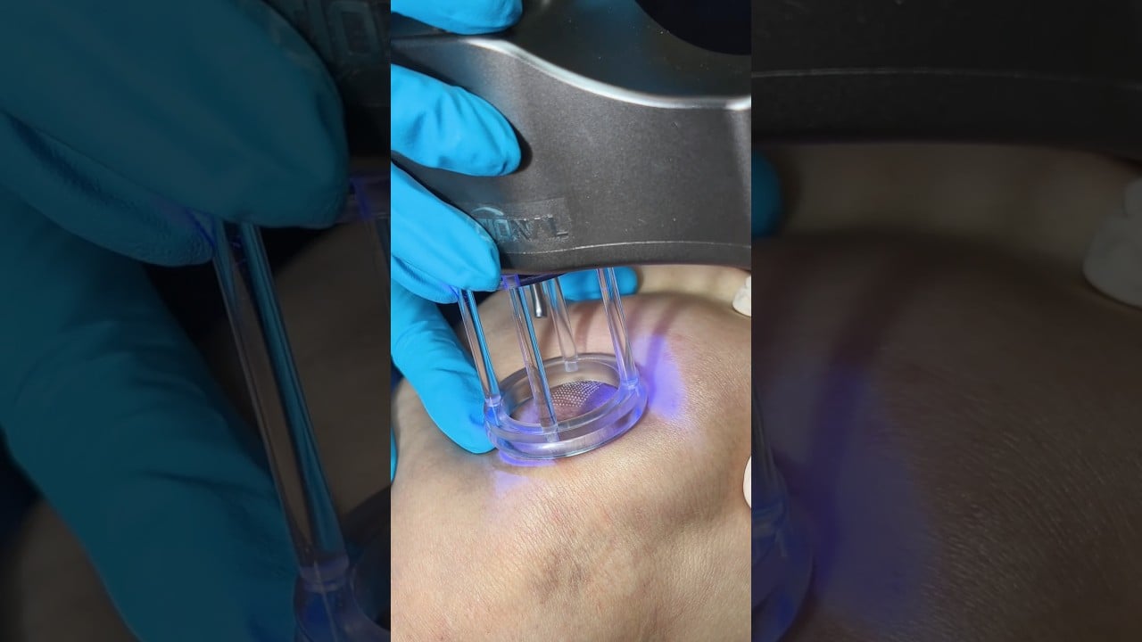 แผลเป็น 5 ปี คิดว่าไม่หาย... อย่าเพิ่งถอดใจ ถ้ายังไม่ได้ลองวิธีนี้กับหมอต้าร์ค่ะ  ดีเลิฟเวอรี่คลินิก