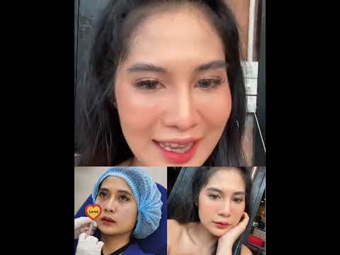 พอใต้ตาไม่คล้ำไม่ลึก แต่งหน้าง่ายขึ้น100% มีแต่คนเคยทำฟิลเลอร์ใต้ตาเท่านั้นที่เข้าใจ