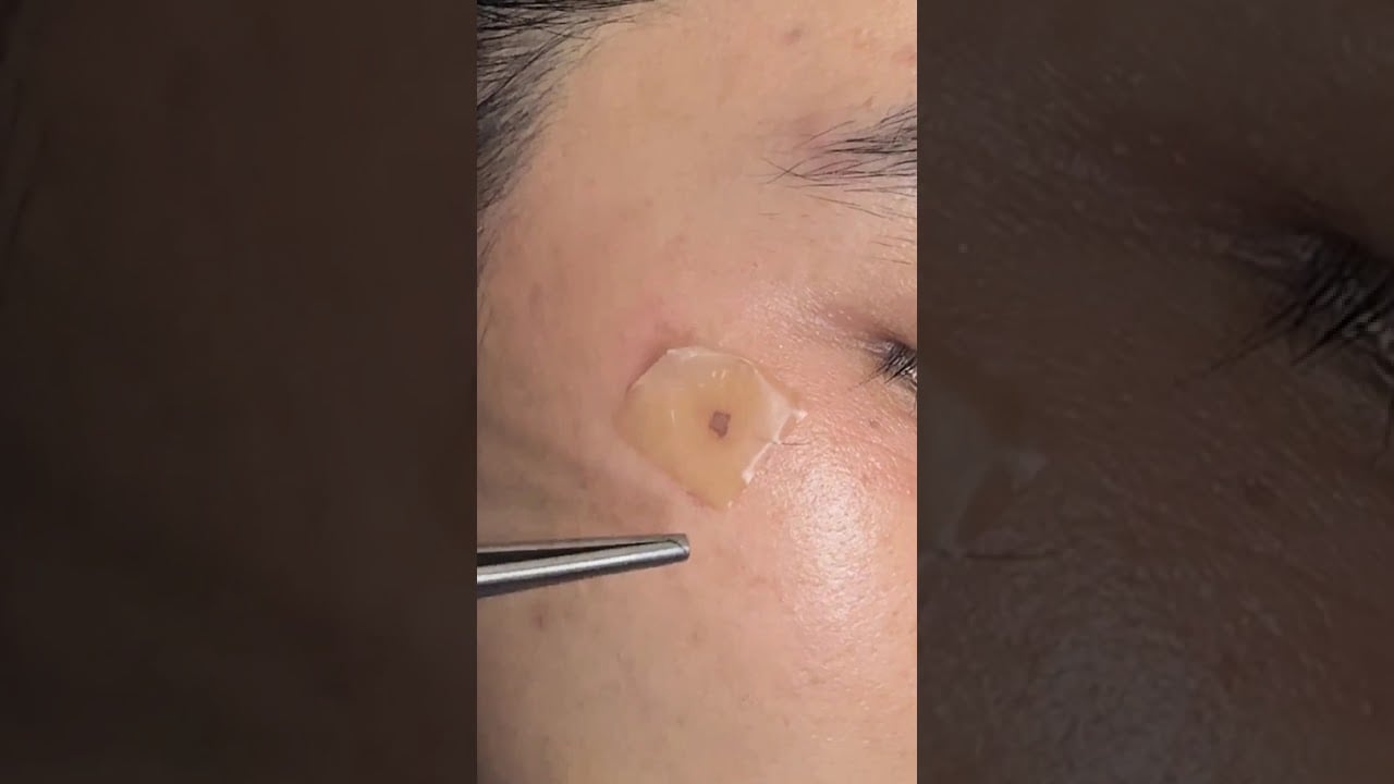 คลิปลอกกระแดด ลอกออกเป็นแผ่นๆ ผสานการรักษาหลายโปรแกรม ราคาเริ่มต้นจุดละ 1000 บาท ส่งภาพประเมินได้เลย