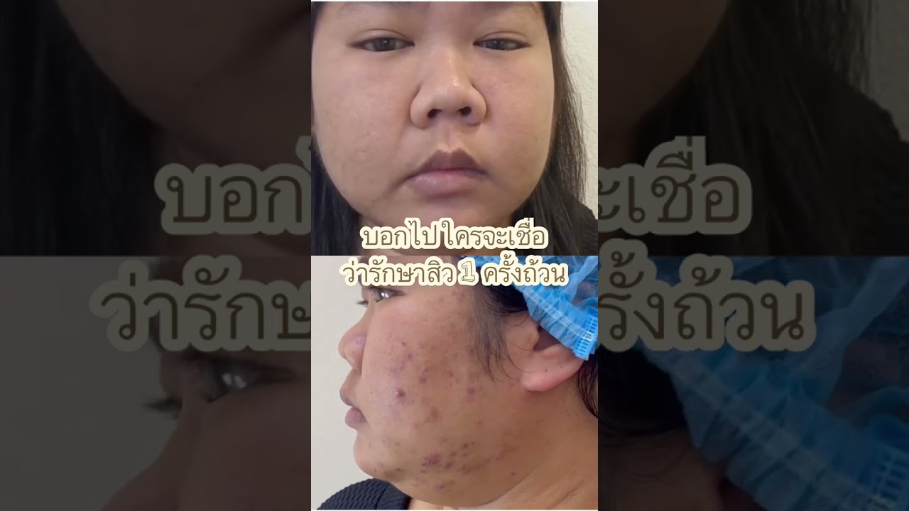 บอกไปใครจะเชื่อ ว่าเคสนี้รักษาสิวเพียงครั้งเดียว หาคลินิกรักษาสิวย่านรามคำแหง ดีเลิฟเวอรี่คลินิก
