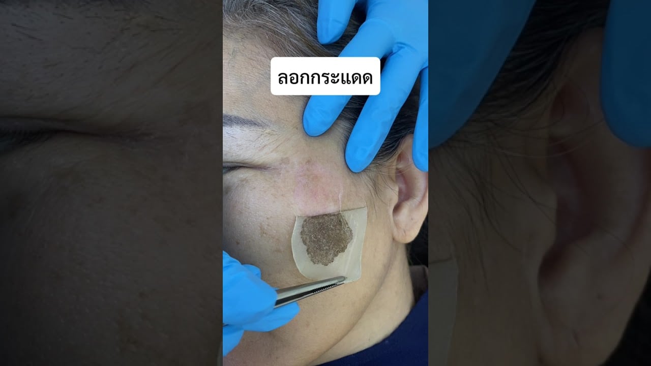 ลอกกระแดด เคสนี้ เหมือนได้หน้าใหม่ เพราะขนาดของกระแดดนั้นเท่ากำปั้นเด็กเลย #ดีเลิฟเวอรี่คลินิก