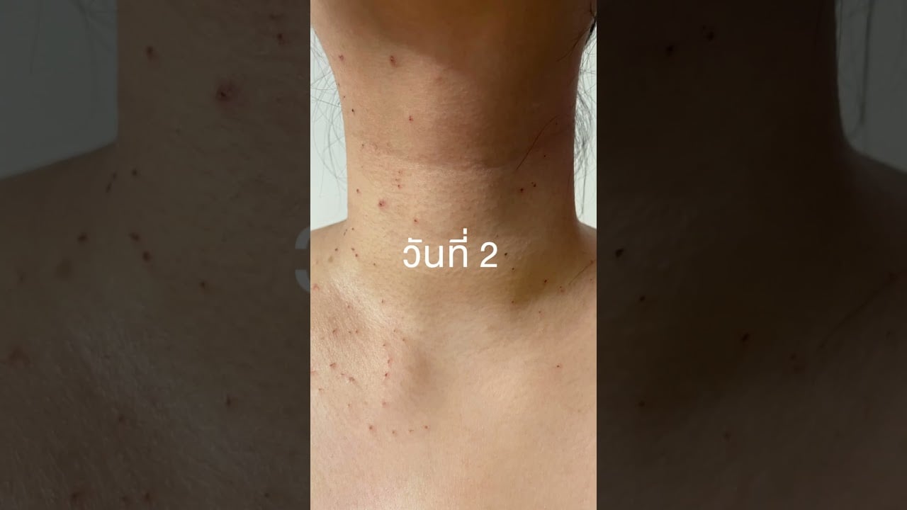 100% คนไข้มาจี้ Co2 Laser กลัวการมีแผลเป็น หมอให้ดูตัวอย่างเคสนี้นะคะ ว่ารอยไม่ได้อยู่ถาวรค่ะ