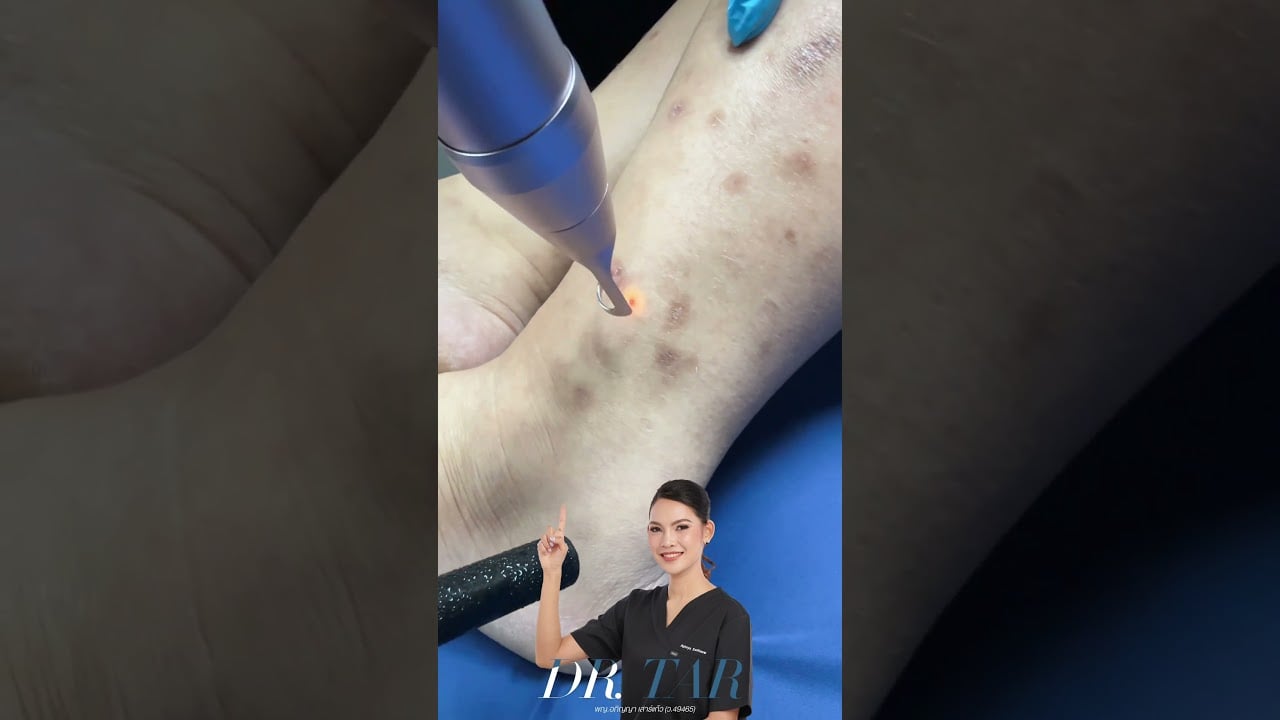 ขาลาย น้ำเหลืองไม่ดี... Pico Laser ช่วยได้จริงไหม? หายในครั้งเดียวหรือเปล่า?