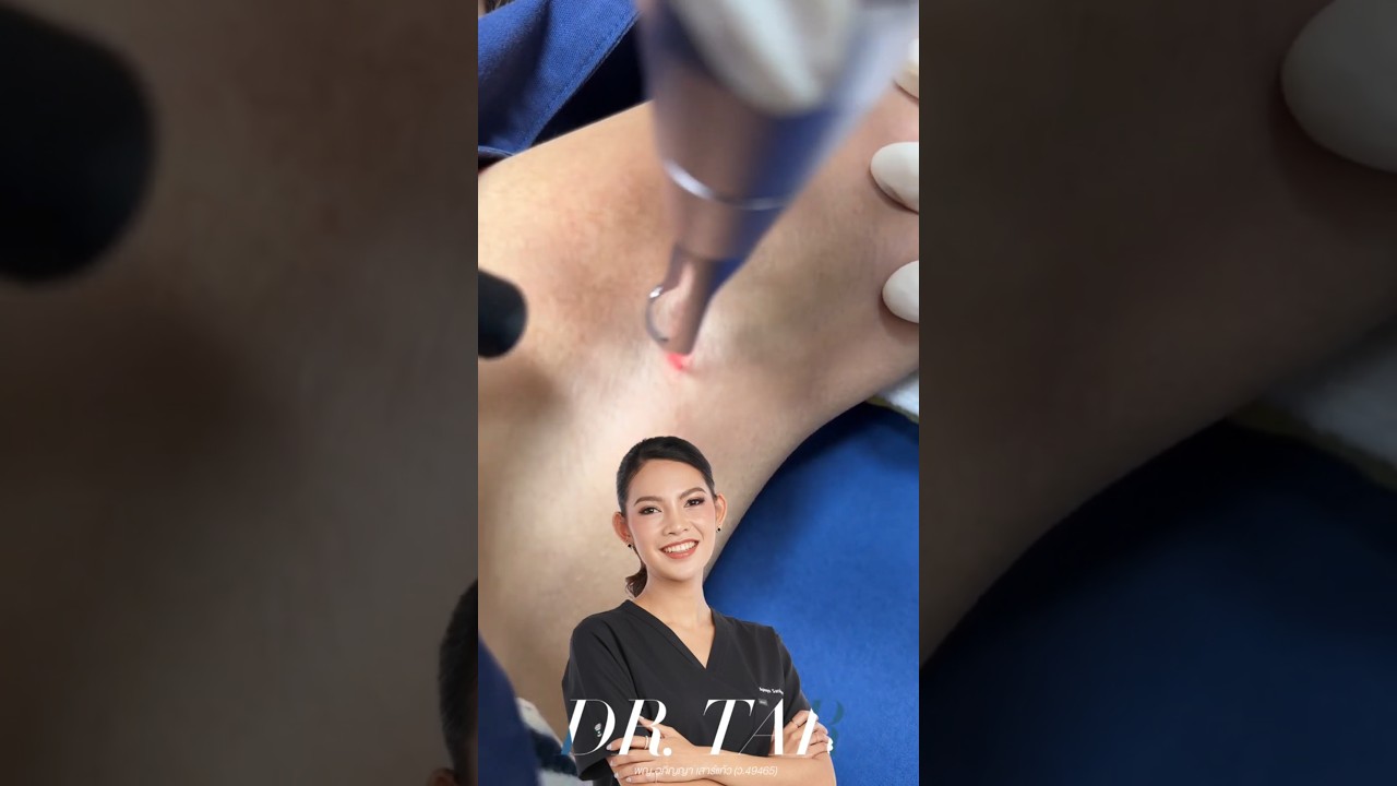 รักแร้ดำเหมือนฝ้า เกิดจากอะไร? รีวิวรักษาด้วย Pico Laser โหมด Toning [ดีเลิฟเวอรี่คลินิกสาขา CDC]