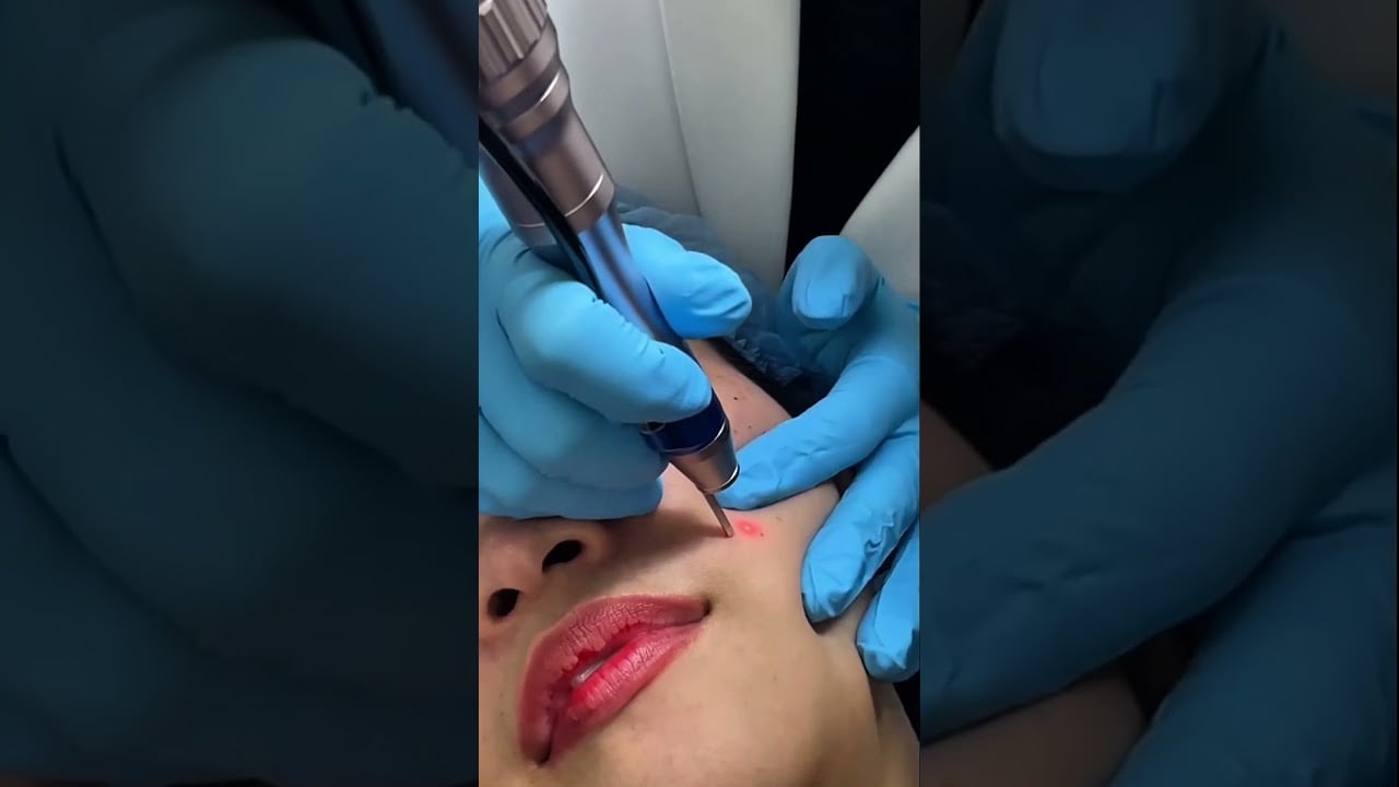 ใครว่าทำเลเซอร์ต้องเครียด? เรายกระดับประสบการณ์ Co2 Laser ให้คุณได้ผ่อนคลาย ดีเลิฟเวอรี่คลินิก