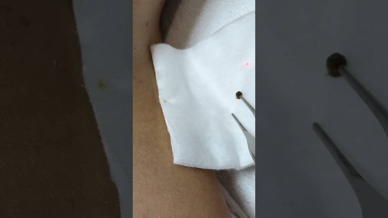 บอกเลยว่าไม่ทันได้เจ็บ ก็หลุดแล้ว จี้กระเนื้อเม็ดใหญ่ เม็ดเล็ก ด้วย Co2 เลเซอร์  #ดีเลิฟเวอรี่คลินิก