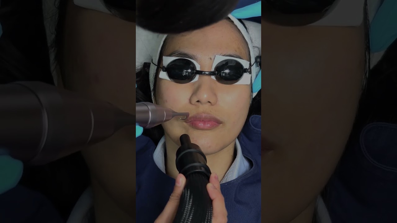 Pico laser เจ็บไหม ตอนทำเป็นยังไง ใครไม่เคยทำลองดูคลิปนี้ก่อน  #ดีเลิฟเวอรี่คลินิก ครั้งล 4,500 บาท