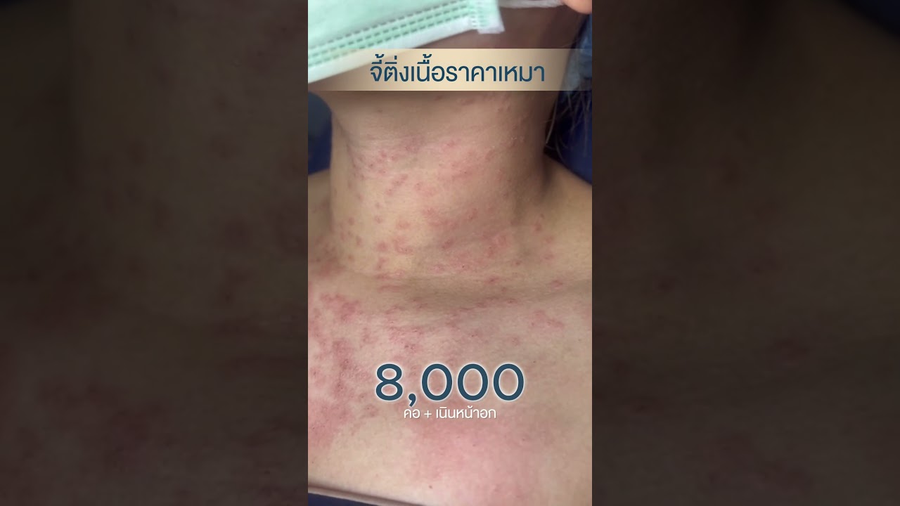 รีวิวจี้ติ่งเนื้อเหมาๆ ทั้งคอ-เนินอก 8,000 บาท! ผิวใหม่ใน 7 วัน ที่ D' Lovevery Clinic