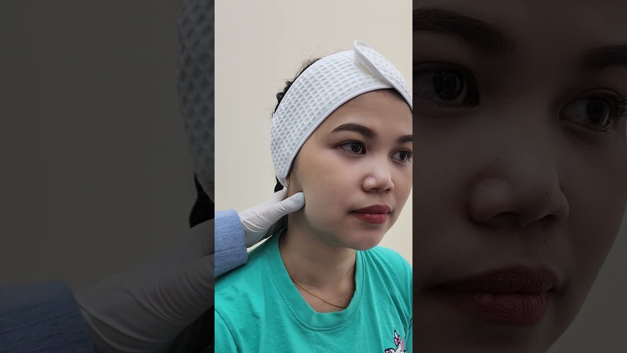 วิธีเช็คกราม กล้ามเนื้อกรามใหญ่ ทำให้หน้าดูกลม ไม่เรียว ก่อนฉีดโบท็อกซ์ลดกราม ต้องเช็คทุกเคส