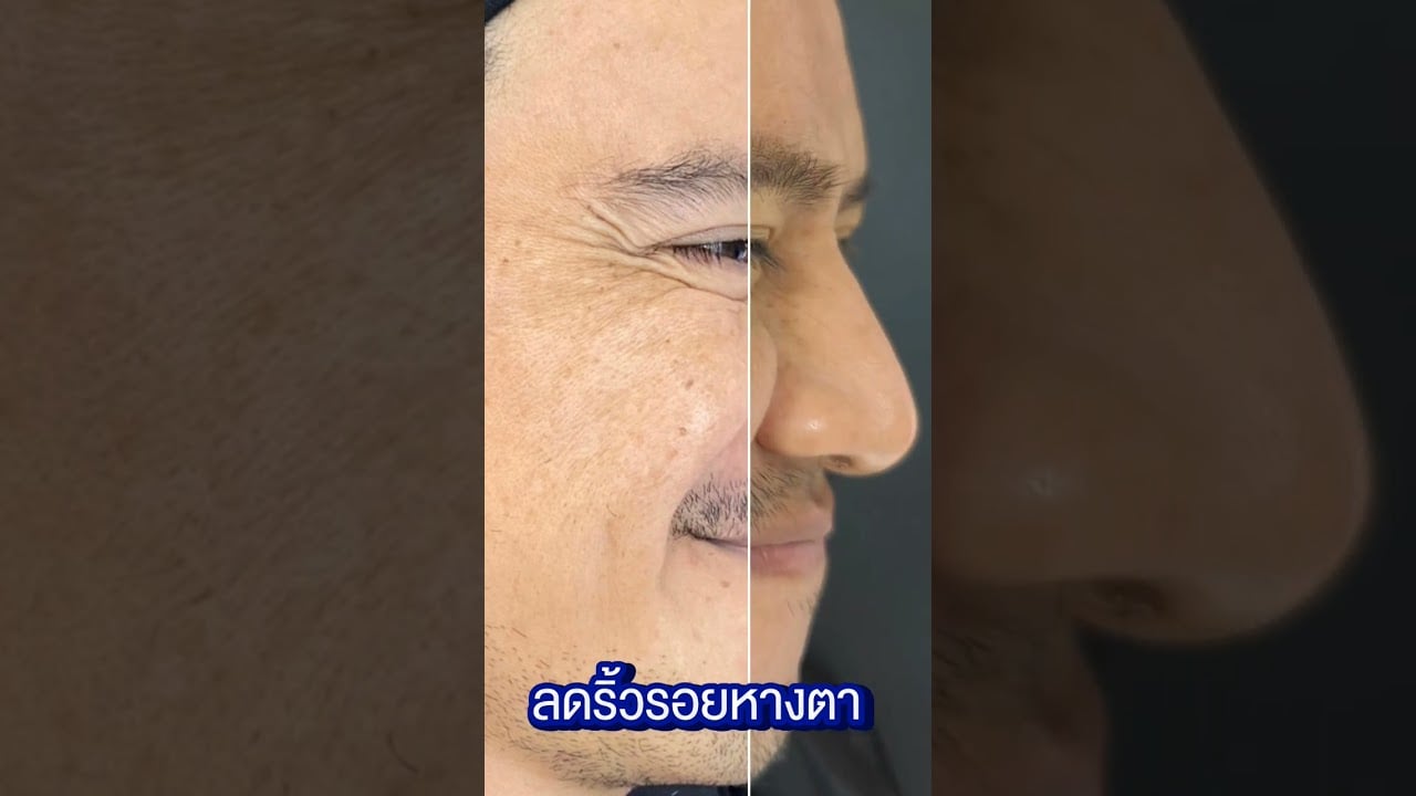 โบนิว ลดริ้วรอย เห็นผลเร็วใน 2-4 วัน ออกฤทธิ์นาน 4-6 เดือน ดีเลิฟเวอรี่คลินิก พาซิโอ รามคำแหง