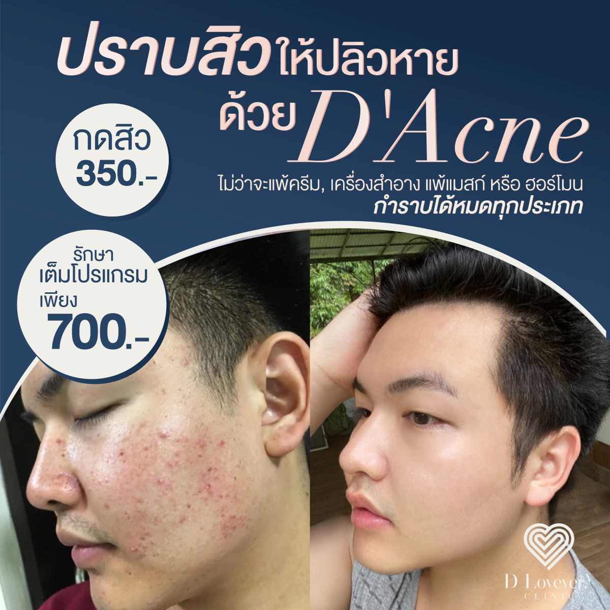 รักษาสิว 700 บาท เคลียร์สิวเกลี้ยง