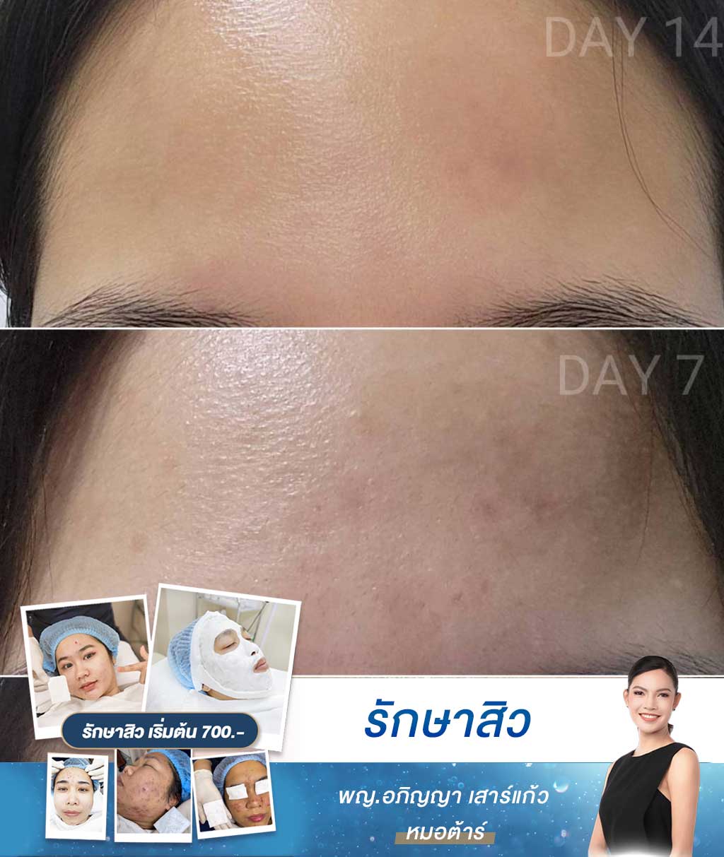 รีวิวรักษาสิว-หน้าผาก-หมอต้าร์-รักษาสิว-รามคำแหง-บางกะปิ-เสรีไทย