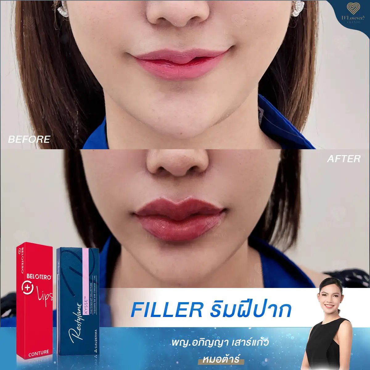 Review of lip filler treatment for fuller, plumper lips: Catty, by Dr. Tar.