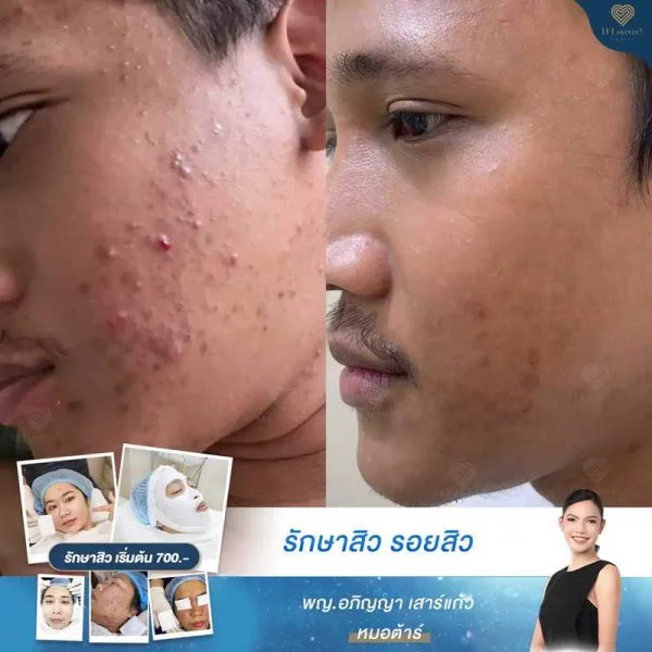 รีวิวรักษาสิวอักเสบ อุดตัน สิวผด สิวหลัง หมอต้าร์ D' Lovevery clinic_16