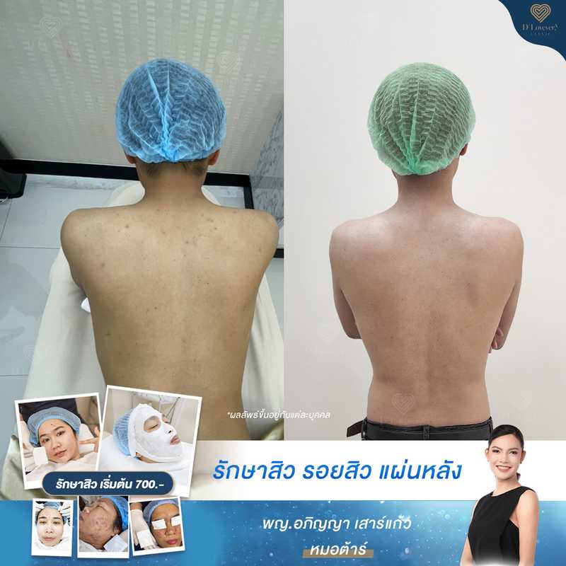 ทำ IPL ที่หลัง ราคาดี 2,500.- พิกัดดีเลิฟเวอรี่คลินิก สาขา CDC และ รามคำแหง