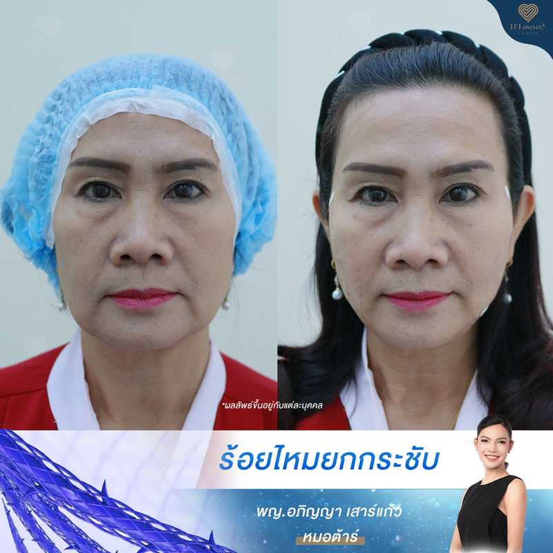 รีวิวร้อยไหม หน้าเรียว หมอต้าร์ D' Lovevery clinic_2