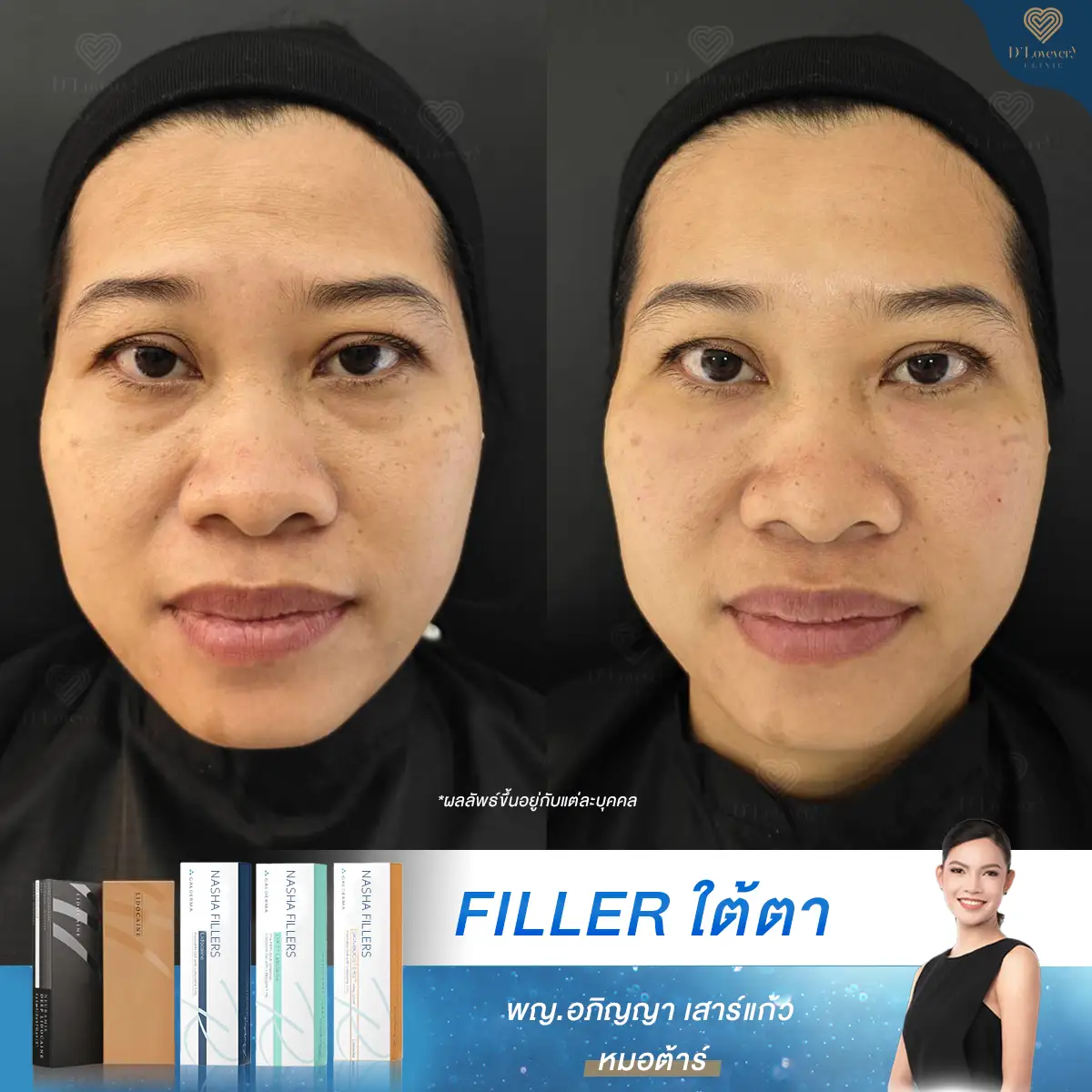 Review of Ultra V Hyal filler injection for under-eye area, price 7999 THB.