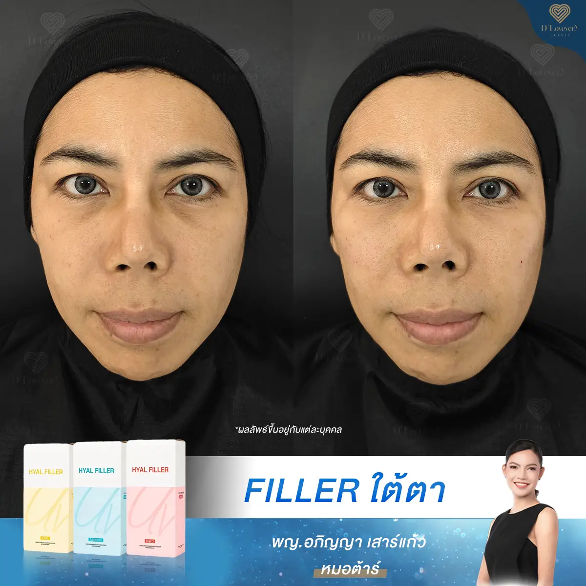 ultra v hyal filler ดีไหม