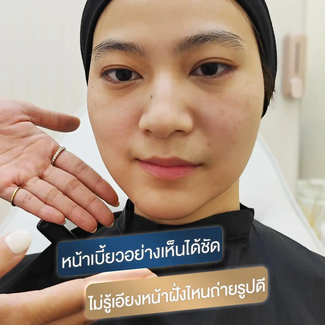 หน้าไม่เท่ากัน ฟิลเลอร์ปรับรูปหน้า