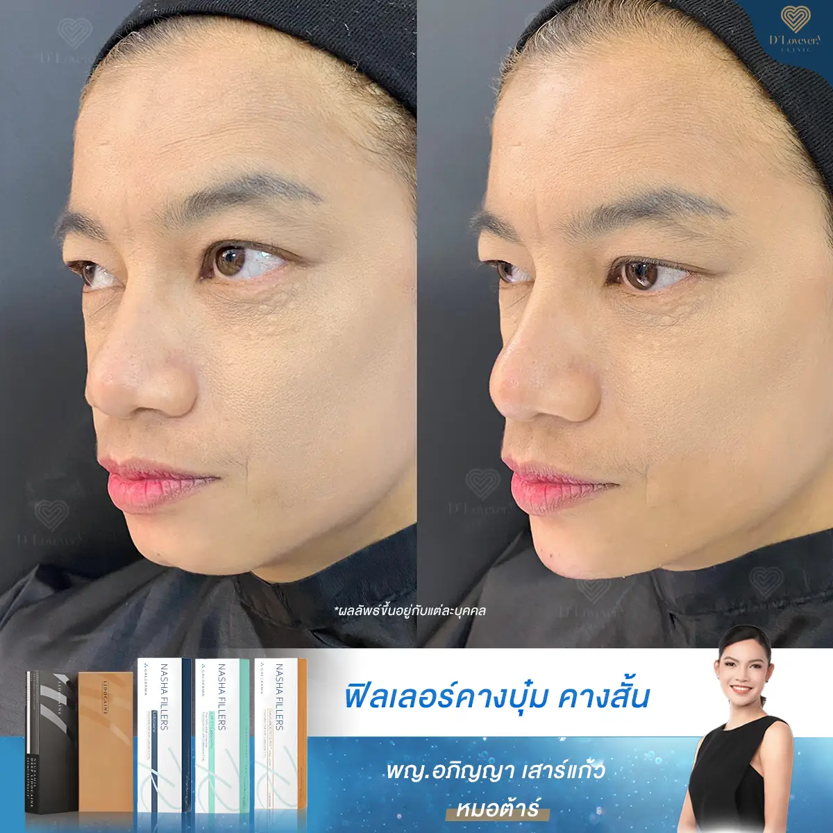 Chin filler, dimpled chin