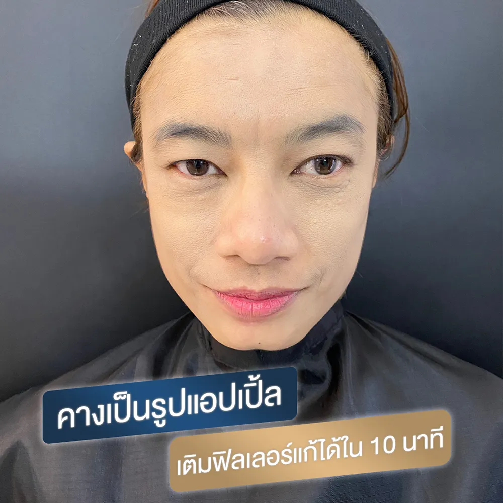 คางตัด คางไม่เรียว