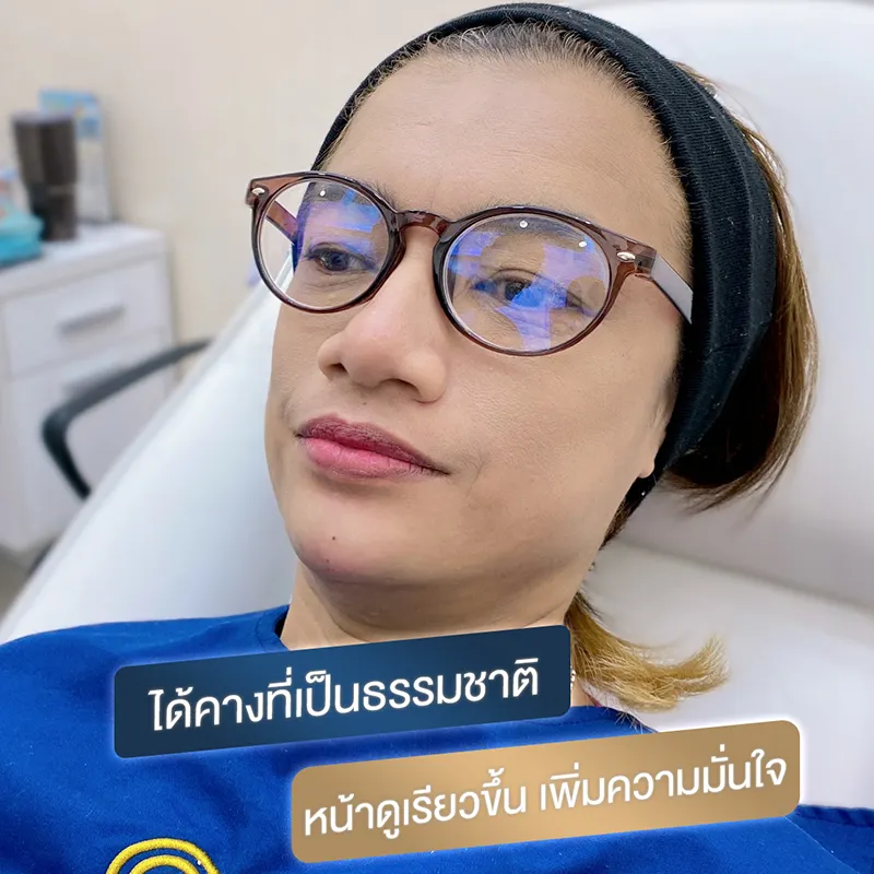 ฉีดคาง ทำหน้าเรียว
