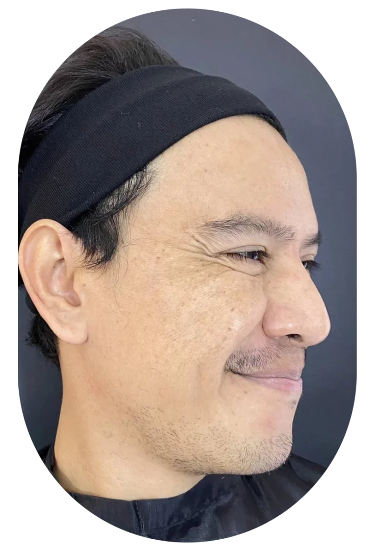 Botox for crow's feet review.