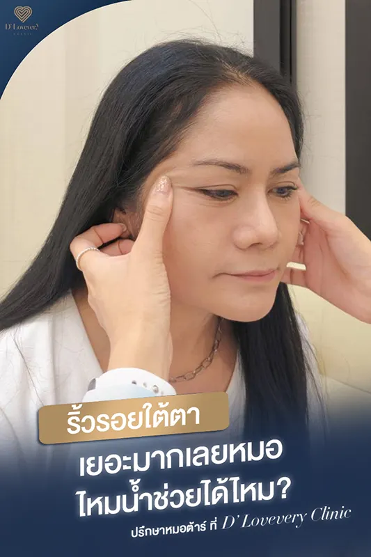 รีวิวฉีดไหมน้ำใต้ตา