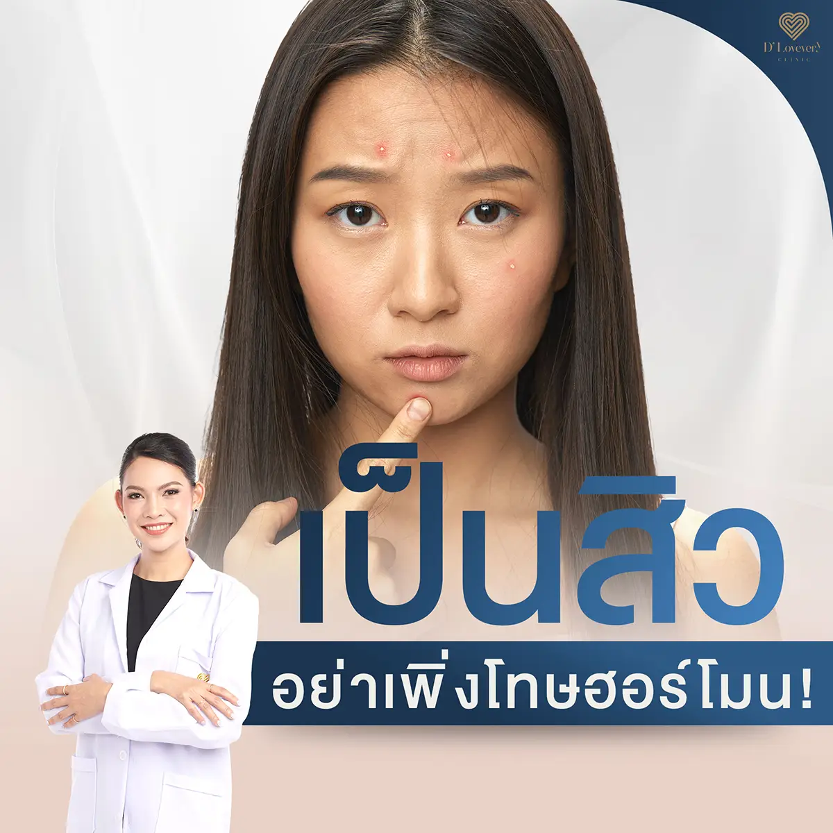 สิว บางครั้งก็ไม่ได้เกิดจากความผิดปกติของฮอร์โมนเสมอไป