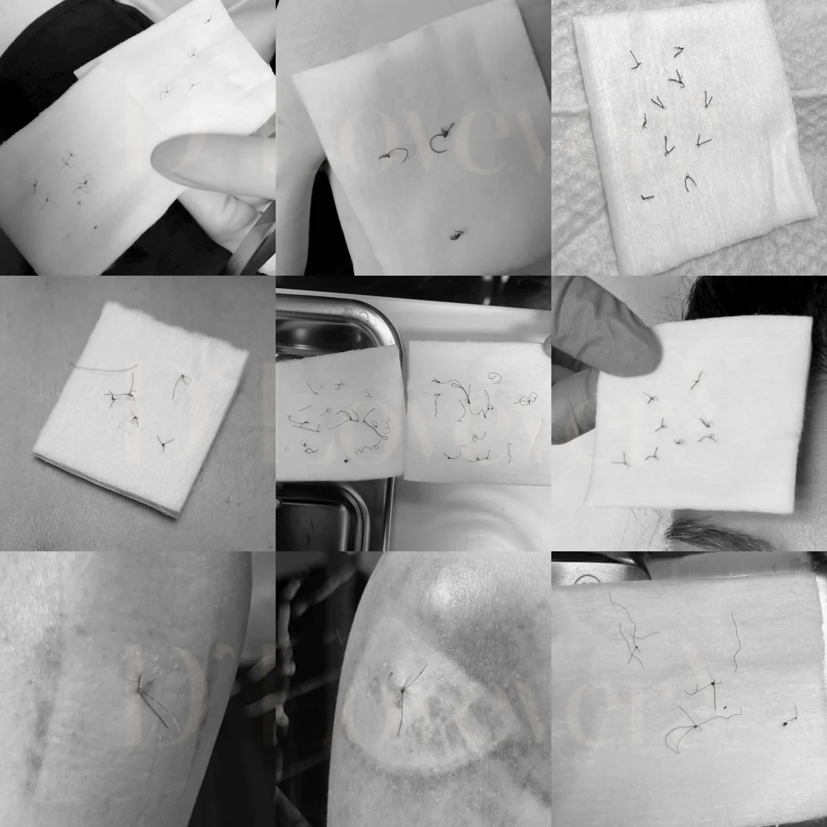 รับตัดไหมศัลยกรรม คลินิกตัดไหม ราคาเริ่มต้น 1000