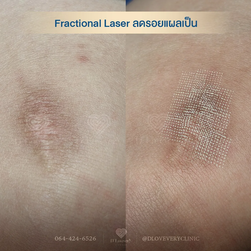 ใครที่มีรอยแผลเป็นฝังใจ จะ 5 ปี หรือ 10 ปี แล้วคิดว่า "คงต้องอยู่กับมันตลอดไป" อยากให้ดูคลิปนี้ให้จบก่อนค่ะ