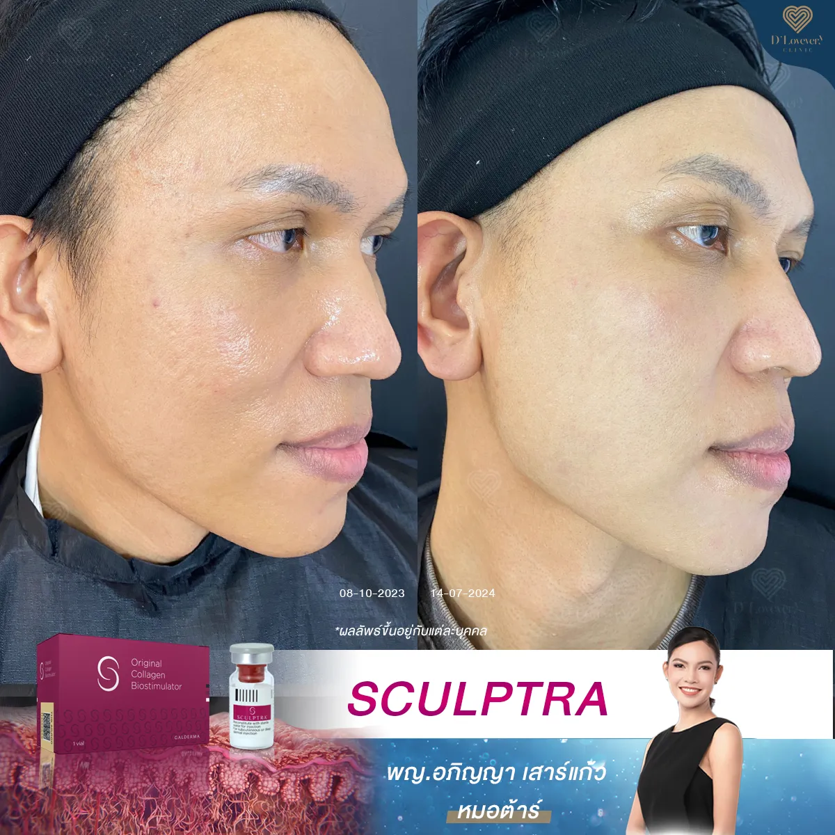 รีวิว sculptra