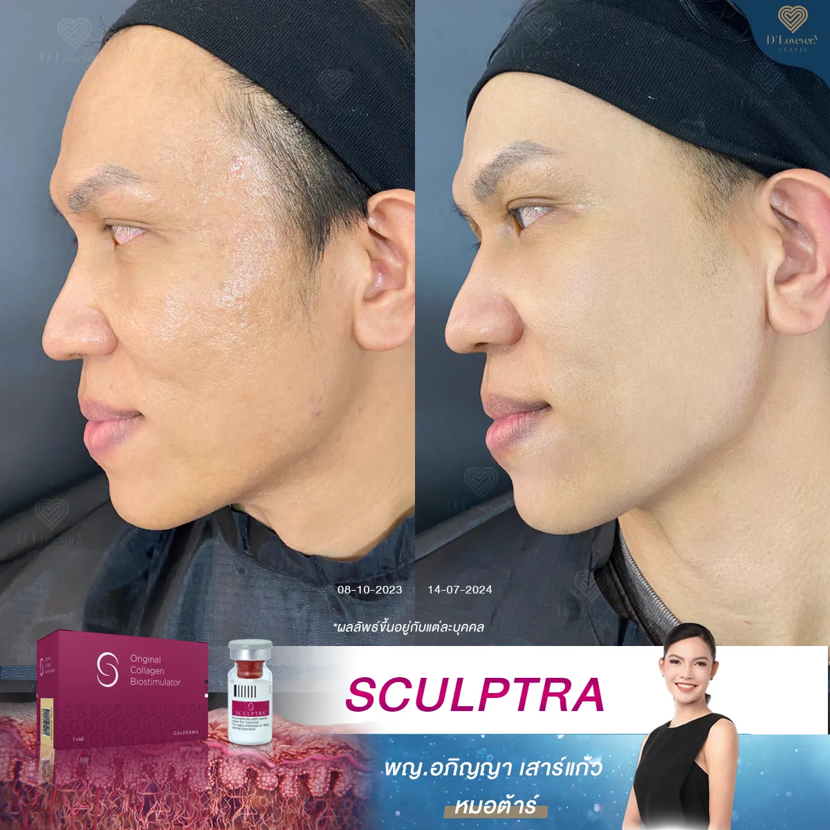 รีวิว sculptra