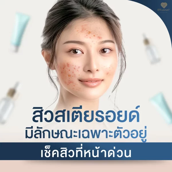 สิวสเตียรอยด์ มีลักษณะเฉพาะตัวอยู่ เช็คสิวที่หน้าด่วน