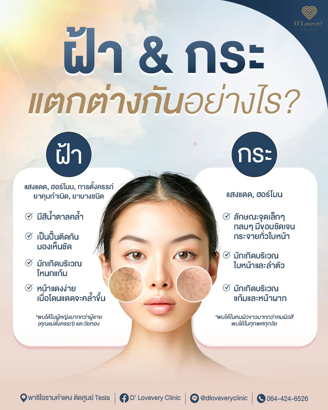 ฝ้า กับ กระ ต่างกันอย่างไร