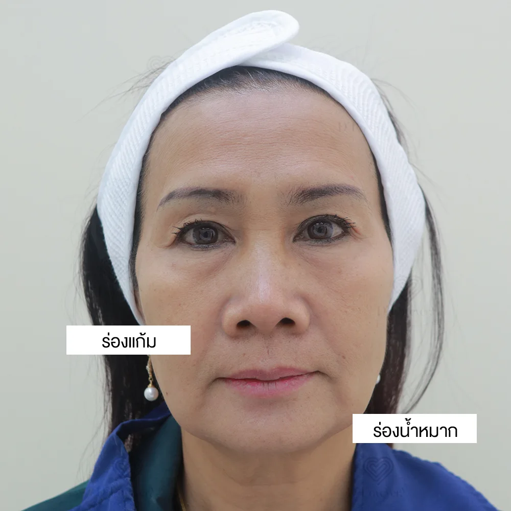 ร่องแก้ม กับร่องน้ำหมาก ต่างกันยังไง