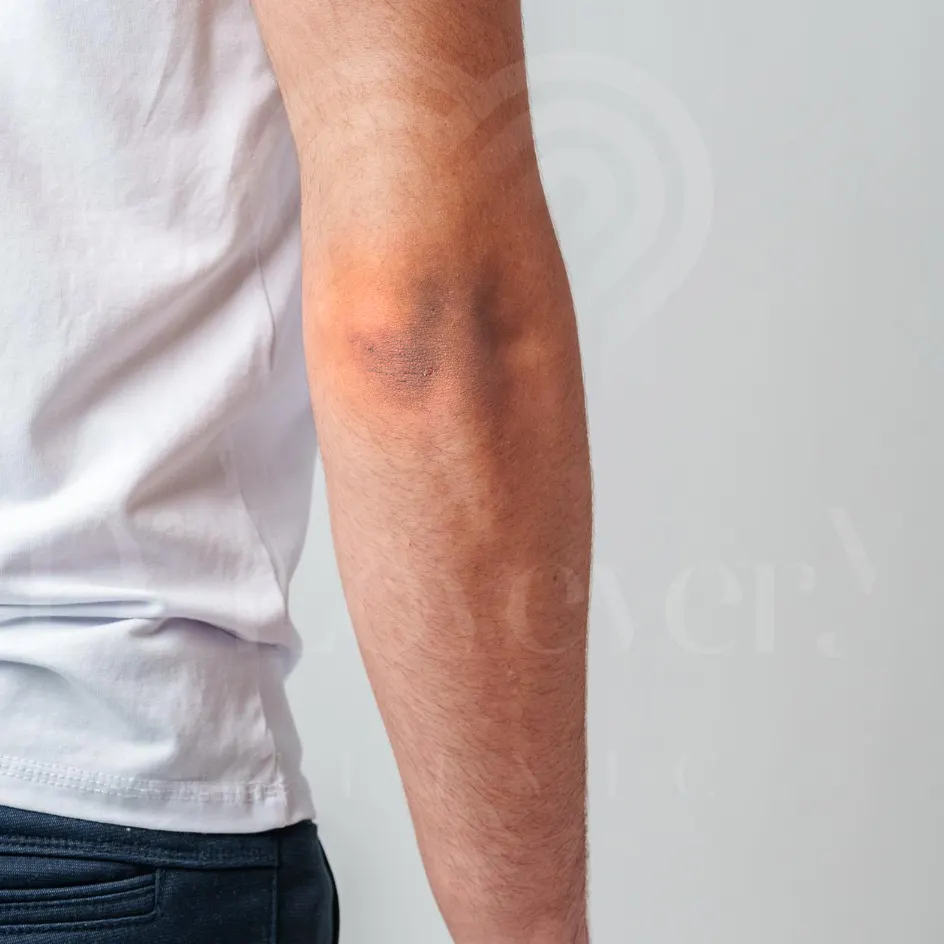 What can I do about dark elbows? Can pico laser help?