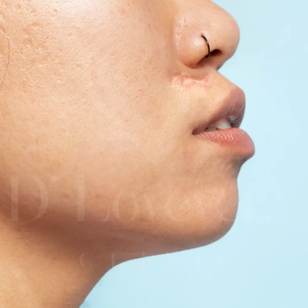 Are keloids on the nose painful when injected or lasered?