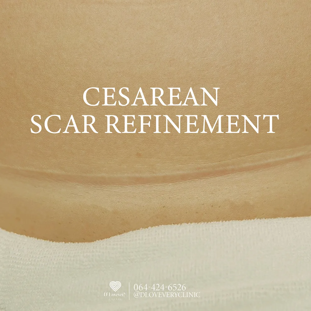 แผลผ่าคลอด ฉีดคีลอยด์ ทำเลเซอร์