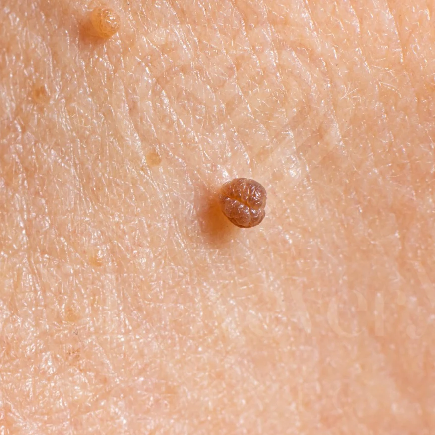 Skin tag removal (or removal of skin tags/moles): A flat rate of 5000 baht for the entire face.