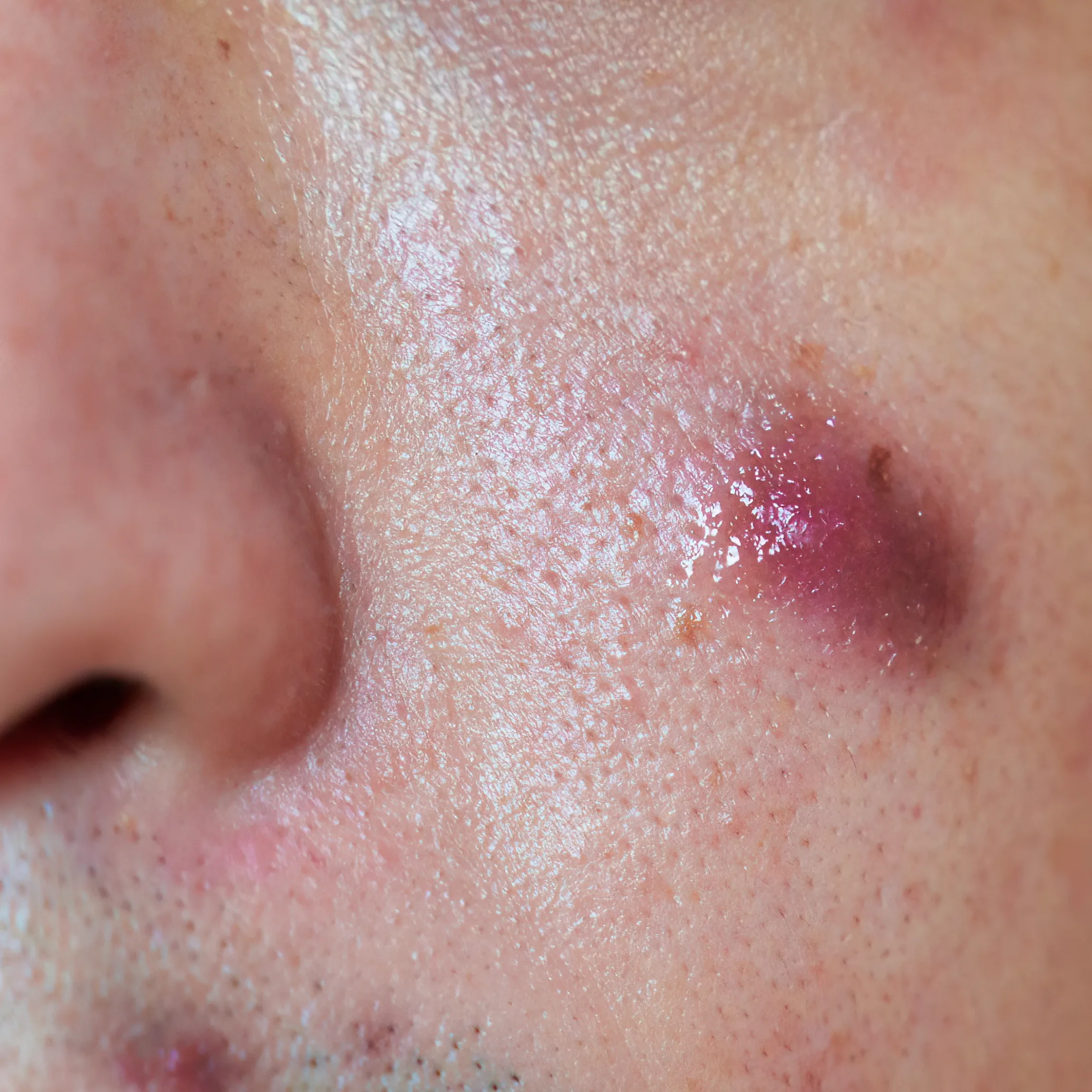 รอยดำสิว รอยแดงสิว pico laser