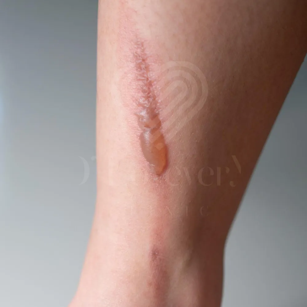 Burn scar pico laser