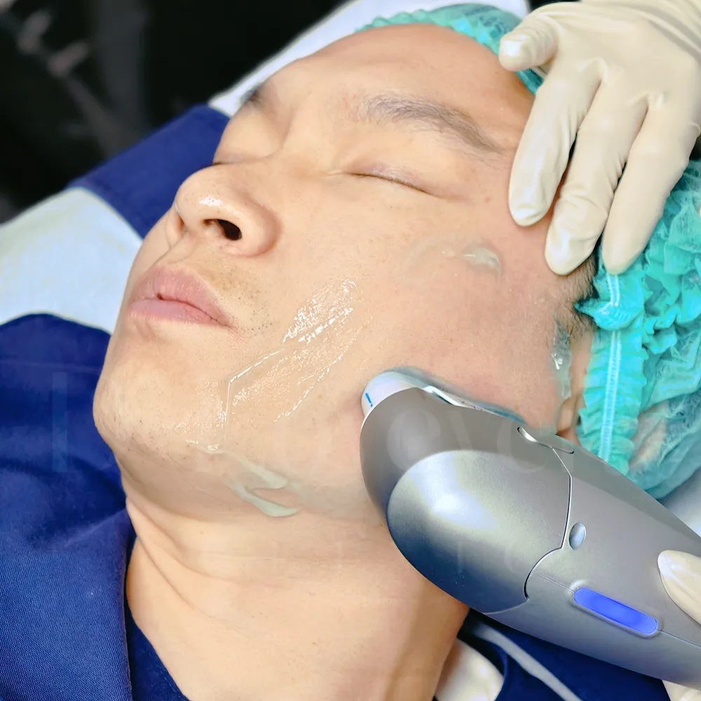 Review of HIFU treatment for men: facial contouring and lifting - dlovevery clinic