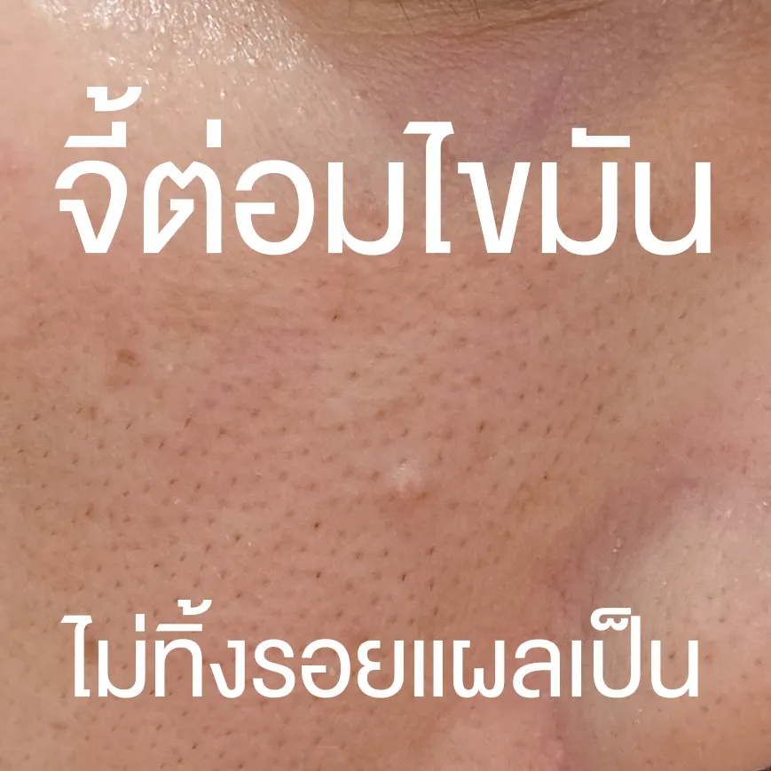 Sebaceous gland cauterization price, mole removal clinic near me.