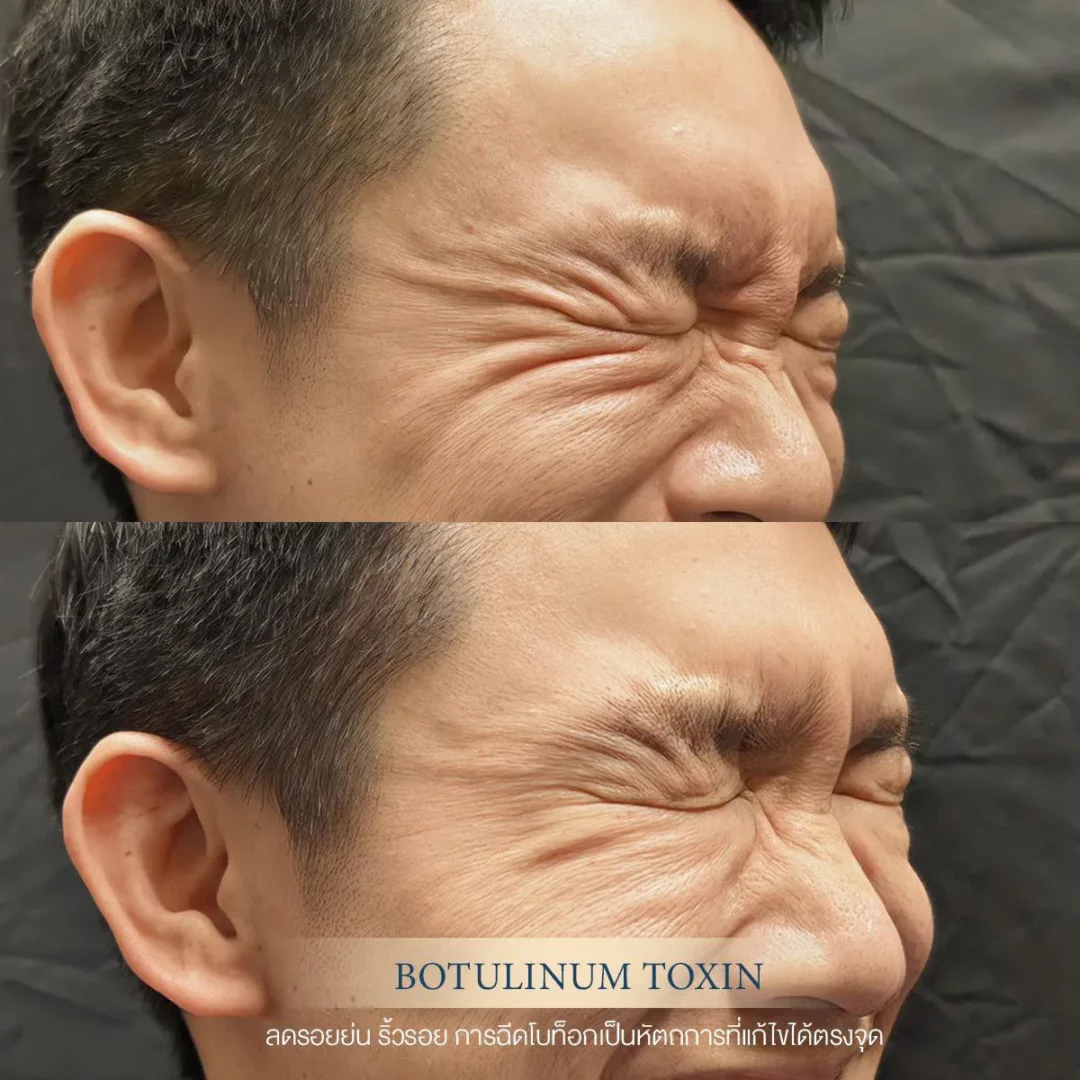 botox เกาหลี โบท็อกซ์ ผู้ชาย ลดริ้วรอย