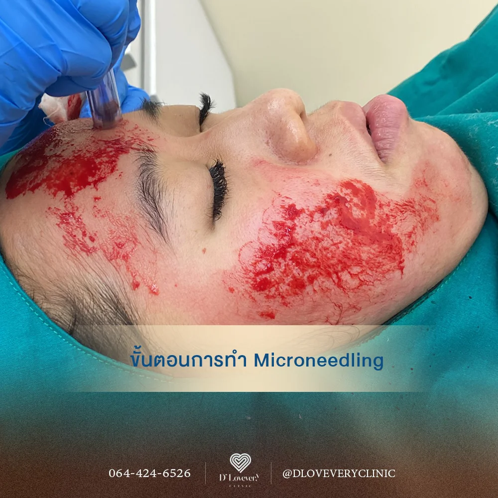 Dermapen + Growth Factor คืออะไร