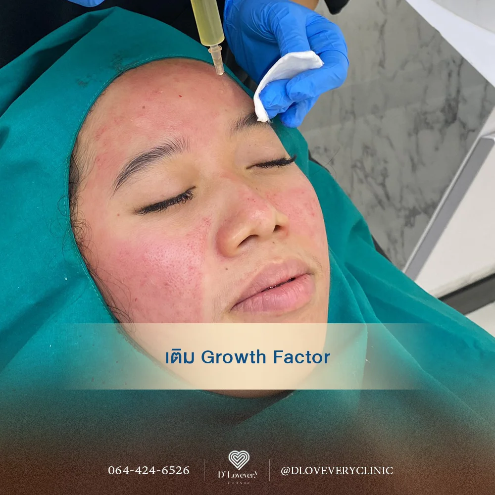 Dermapen + Growth Factor คืออะไร