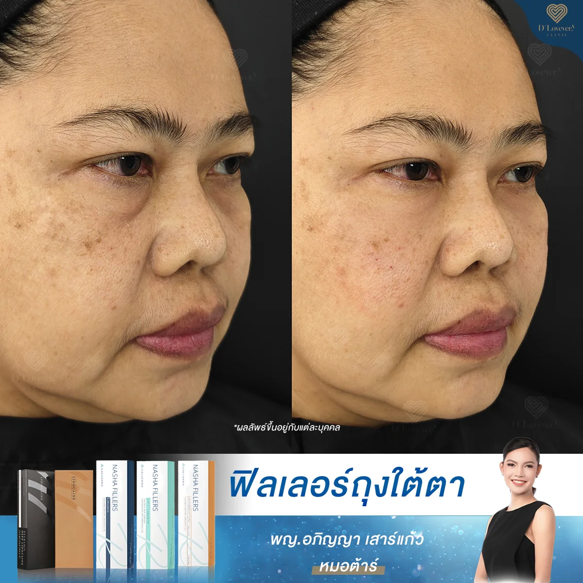 Under-eye filler injection to correct under-eye bags and uneven dark circles. Dr. Tar, Dlovevery Clinic-4.